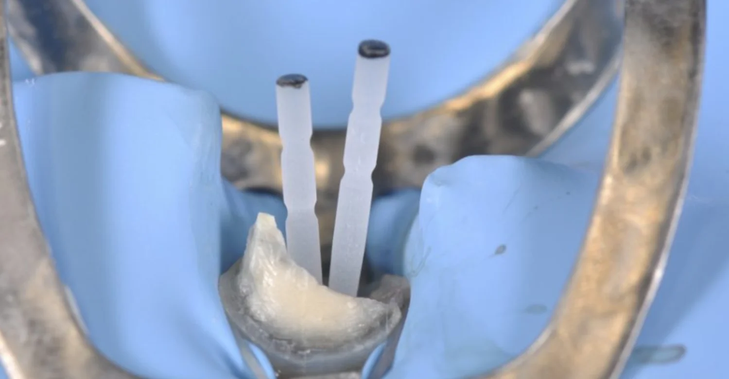 Dental fiber posts and root canal treatment inblog